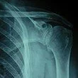 Morfologia e ruolo roto-traslatorio della scapola per la salute del complesso di spalla